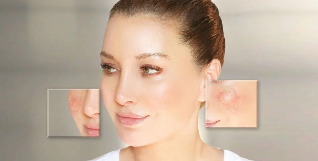 Rosacea Selbsttest