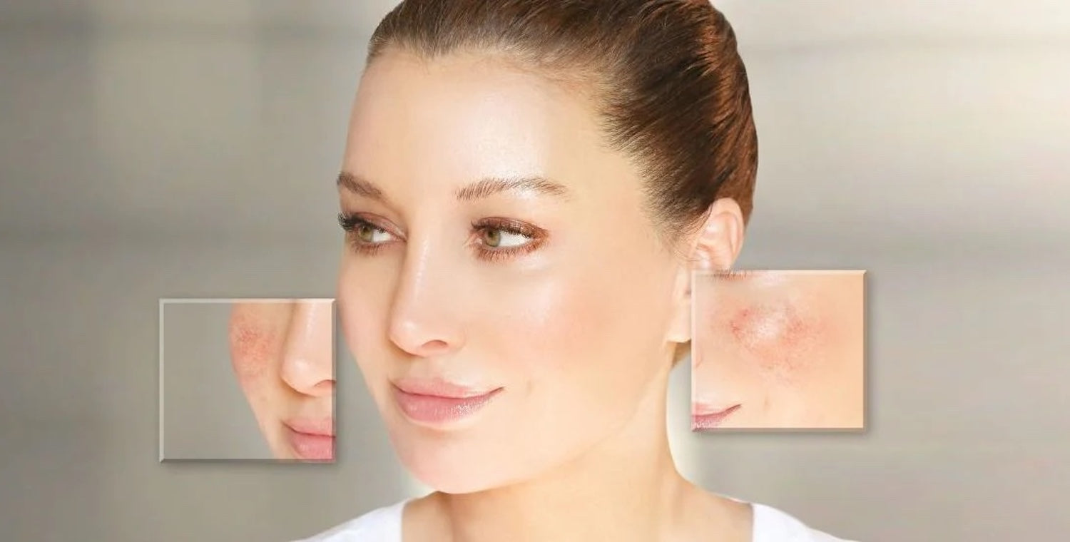Rosacea Selbsttest