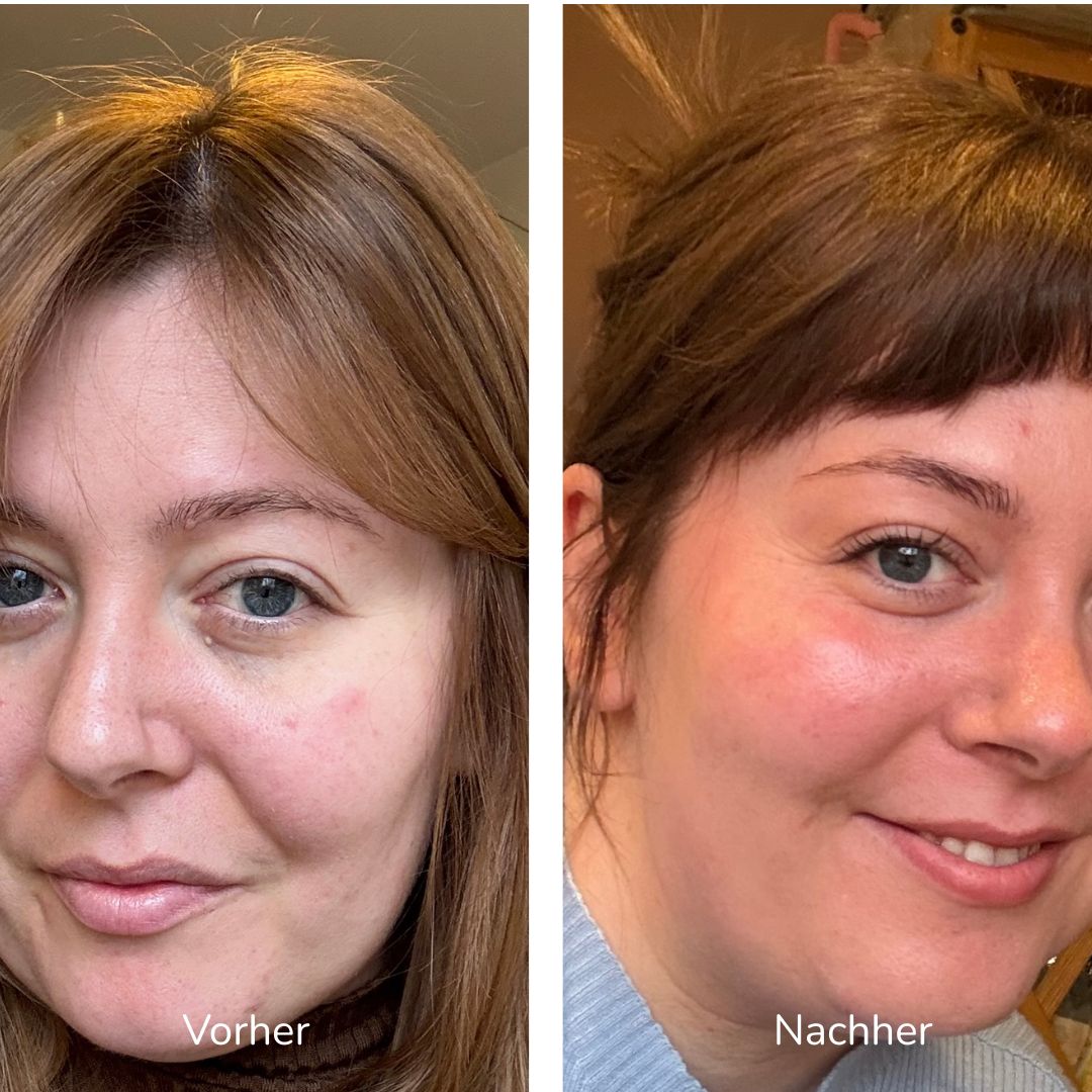 Vorher-nachher-Vergleich der Gesichtshaut in zwei Bildern.