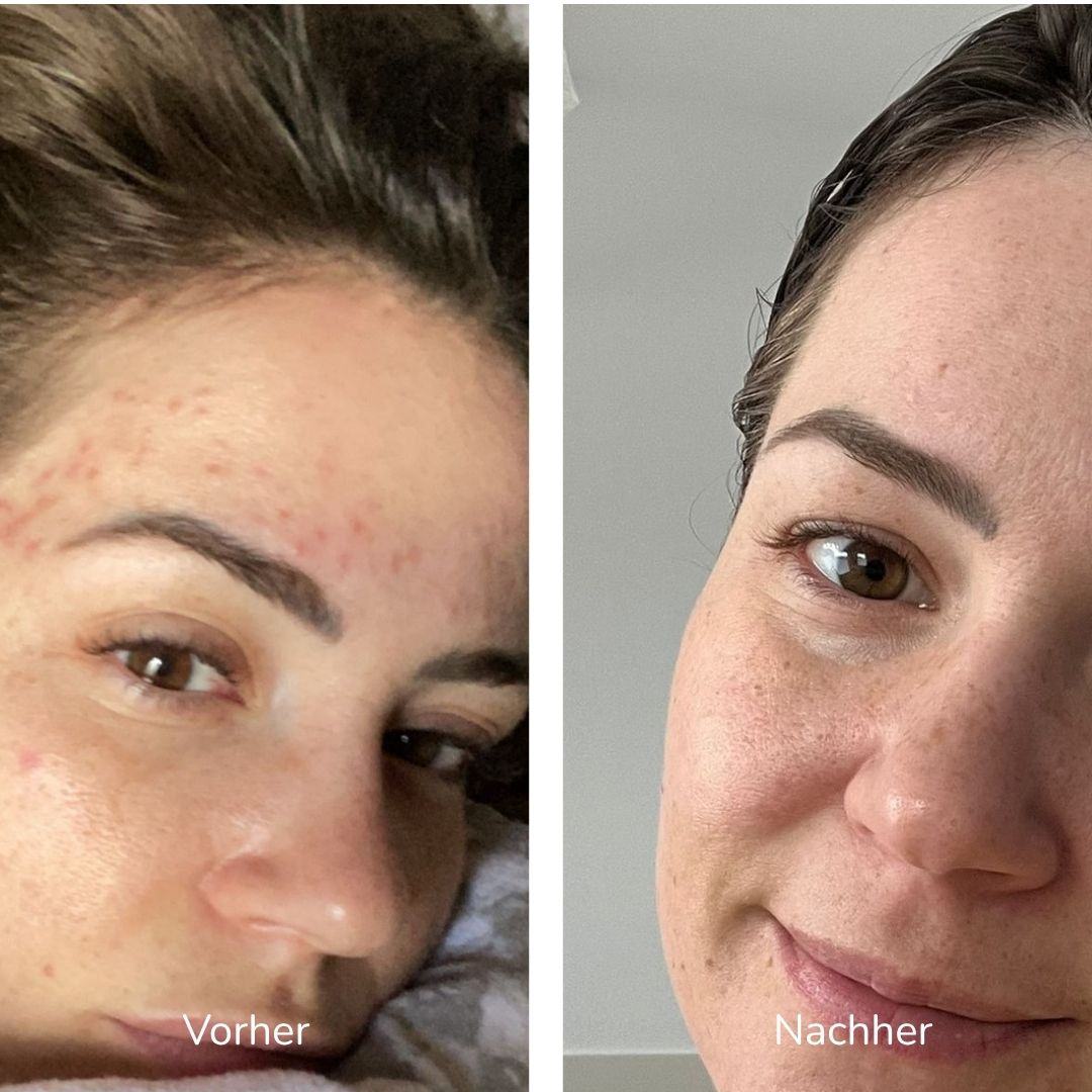 Vorher-nachher-Vergleich der Gesichtshaut in zwei Bildern.