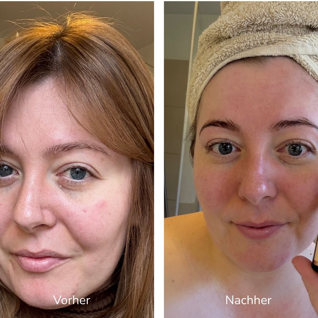 Vorher-nachher-Vergleich der Gesichtshaut in zwei Bildern.