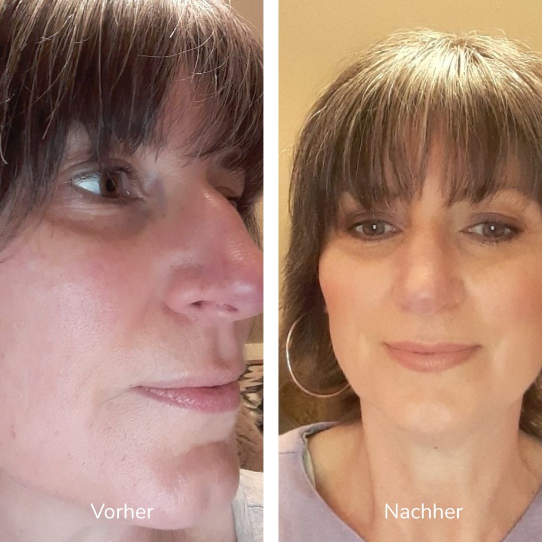 Vorher-nachher-Vergleich der Gesichtshaut in zwei Bildern.