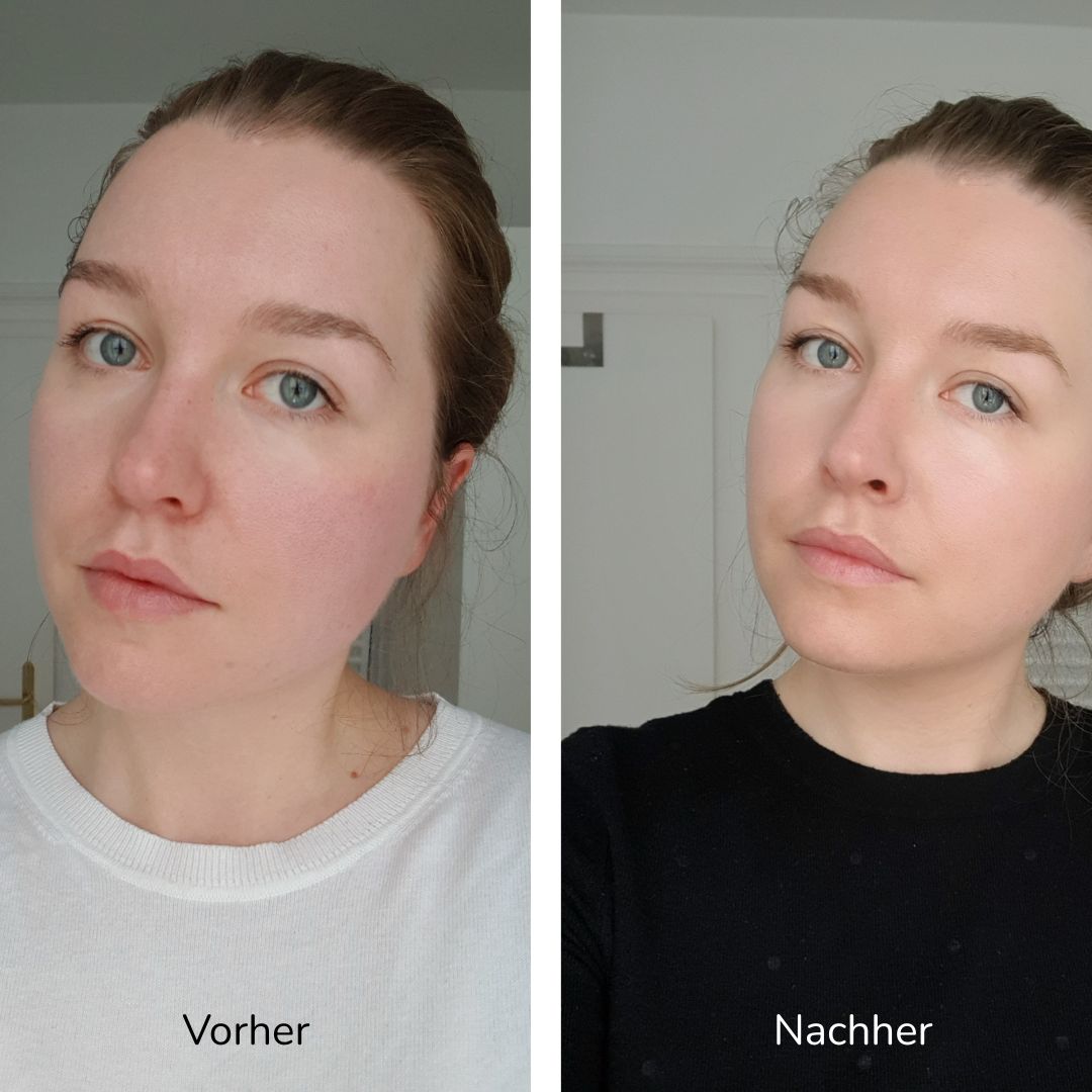 Vorher-nachher-Vergleich der Gesichtshaut in zwei Bildern.
